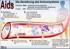 dpa-Grafik: AIDS - die Zerstörung des Immunsystems